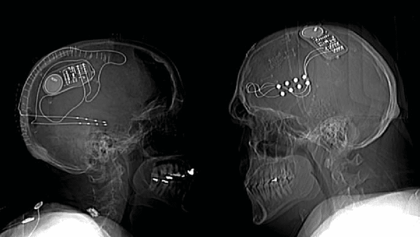 Neuropace X ray
